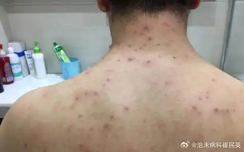 中医##毛囊炎##微博健康公开课