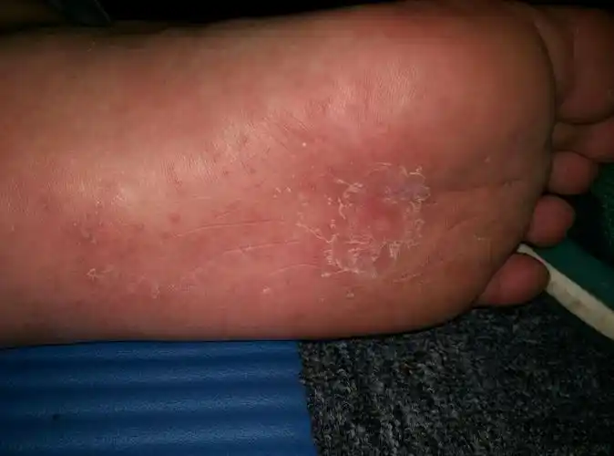 脚底不知道什么多了这么多红点,还掉皮,有点痒.