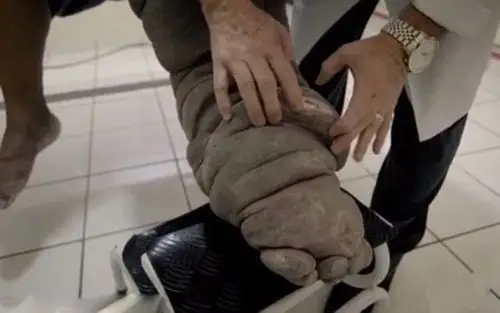 男子雷蒙多(raimundo)20年前因蚊虫叮咬而感染淋巴丝虫病(俗称象皮病)