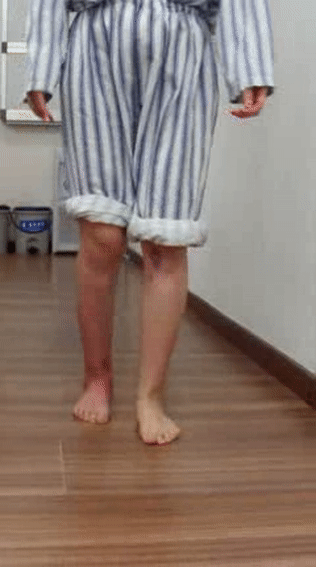 遭遇车祸致残疾姑娘走路拐子脚