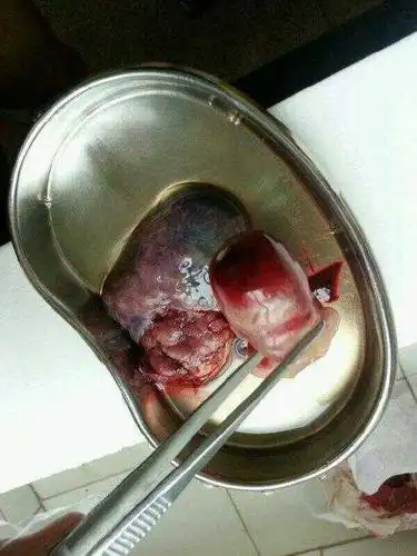 常用中期妊娠引产的方法有依沙吖啶羊膜腔内注射引产,水囊引产等.