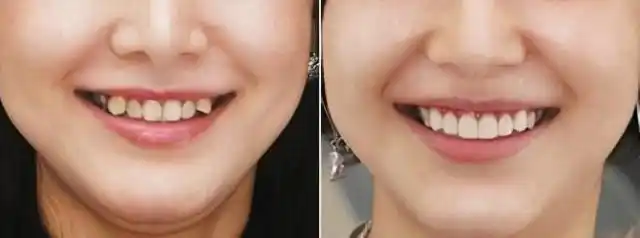 为什么有些人会长虎牙?看似可爱,实际上却很"危险"