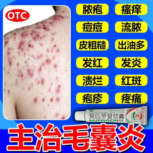 莫匹罗星软膏 后背毛囊炎药专用效药 治疗前胸后背毛囊炎 后背脓疱