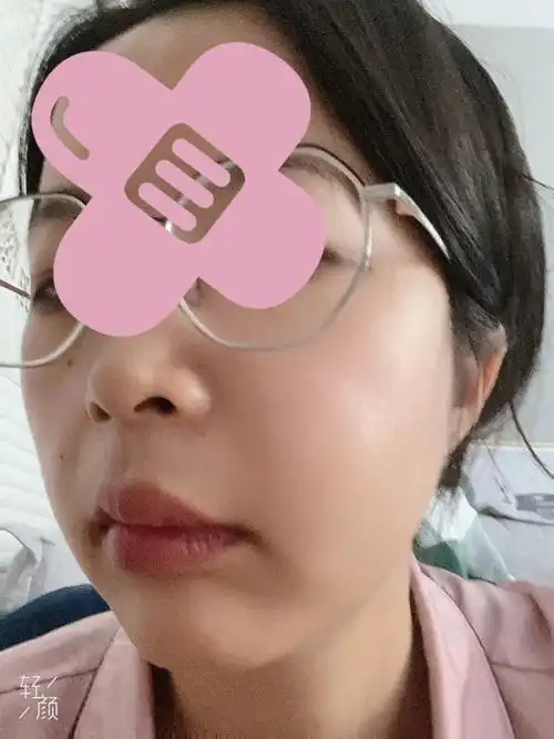 33大龄整牙之拔埋伏虎牙