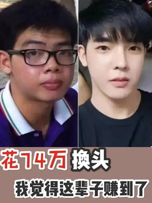 小哥花74万整容从丑男变网红