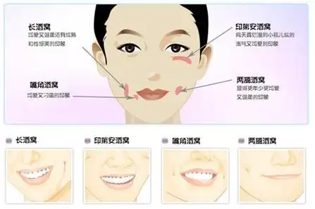 小酒窝很迷人不一定也许还会显老