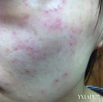 夏季过敏起红疹子的图片三个治疗方法替您解忧
