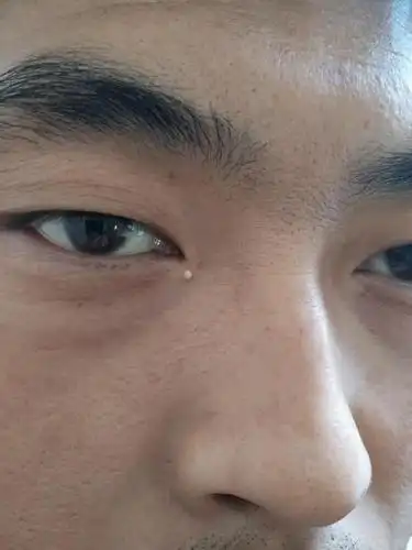 眼角长了个疙瘩,不知道是什么?