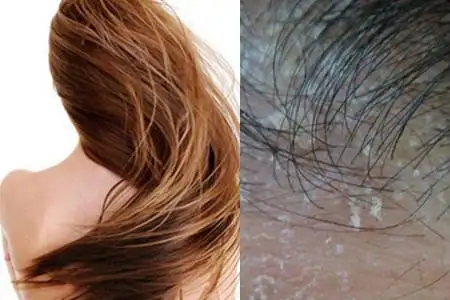 图头皮干燥头屑多怎么办规律日常生活