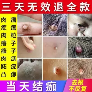 去除肉瘤肉疙瘩肉赘祛瘊子点痦子颈部丝状疣凸痣神器