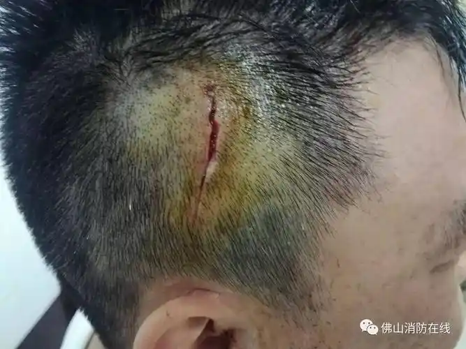 消防队员头部受伤坚持救人