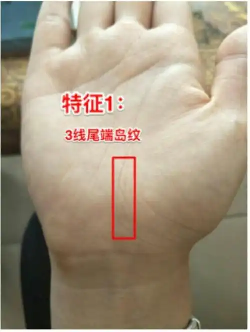 特征1:3线尾端出现2个岛纹相交,或者大岛纹里面有小岛纹