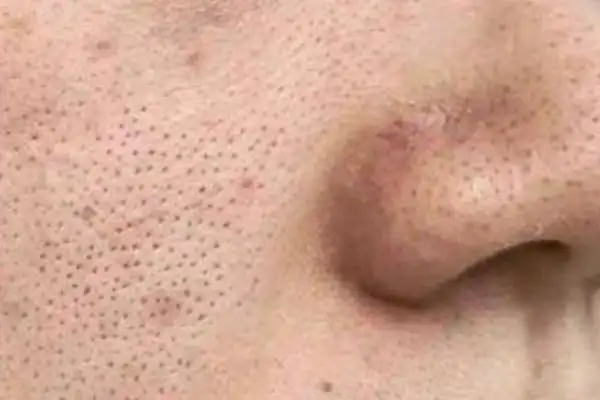 毛孔粗大怎么办怎么收缩毛孔毛孔粗大用什么护肤品可以改善