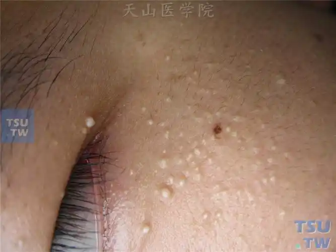 【图】良性肿瘤:粟丘疹(milia)症状表现 - 皮肤病诊断图谱 - 天山医学