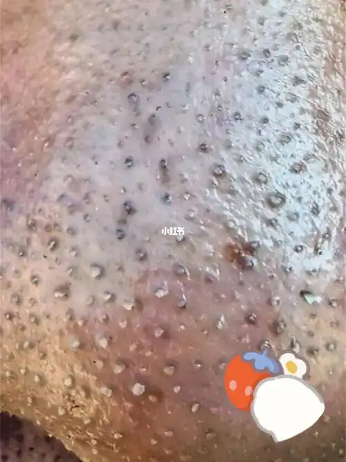 黑头_痘痘_闭合性粉刺_闭口痘痘_湿敷_蜂蜜_清洁_纯净水_美妆_环趑