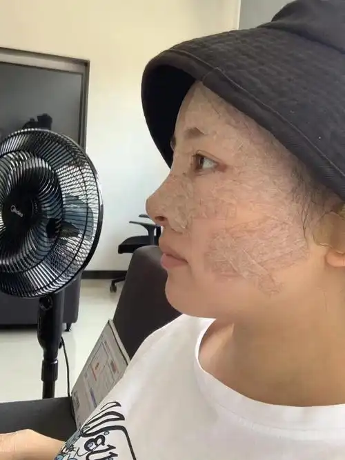 自体脂肪填充全脸第三天;刚做完那会肿胀是真的严重,现在已经好了很多