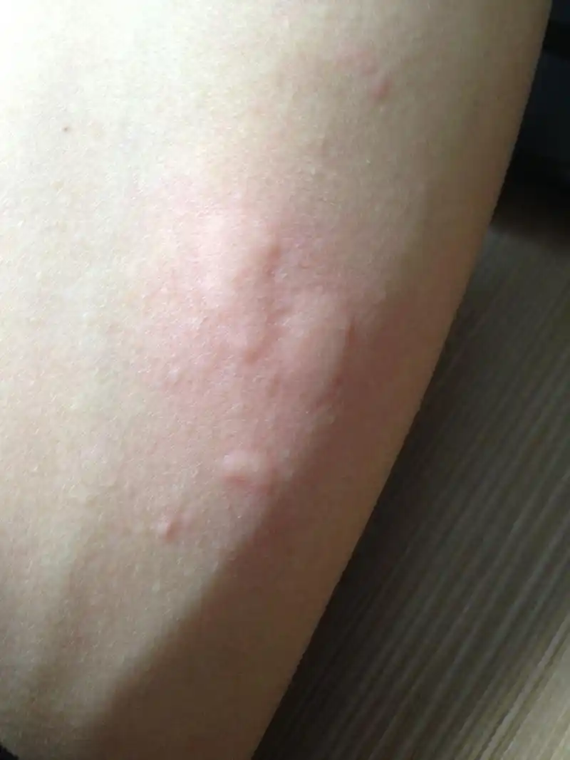 身上这两天起了很多这样的疙瘩 而且很痒 是怎么回事啊 是过敏吗