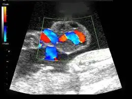 脐带真结较为少见,为妊娠早期(3~4个月)因脐带过长,脐带在宫腔内形成