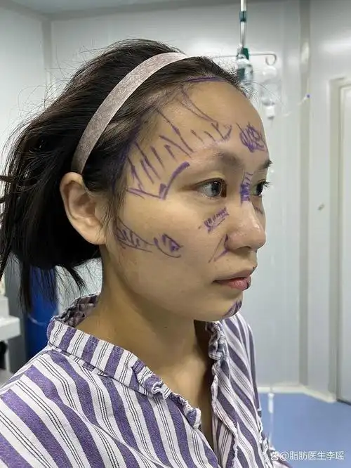 脂肪填充改善面部线条崎岖案例,这是术后7天的一个对比恢复情况