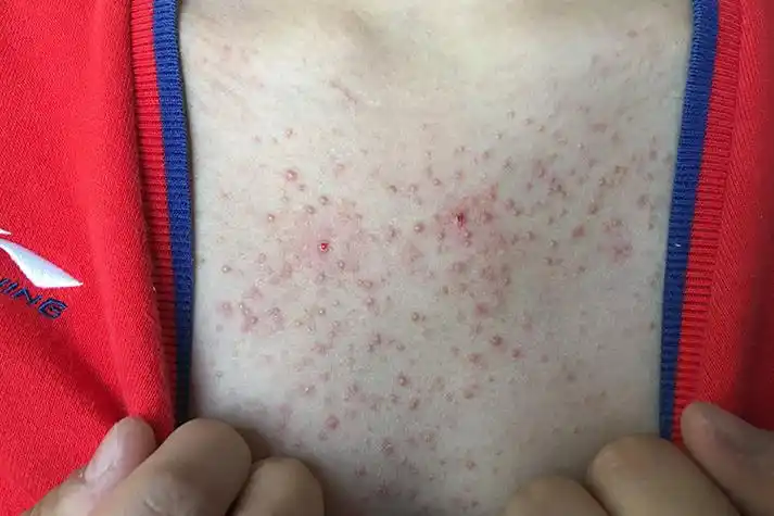 胸前马拉色菌毛囊炎图