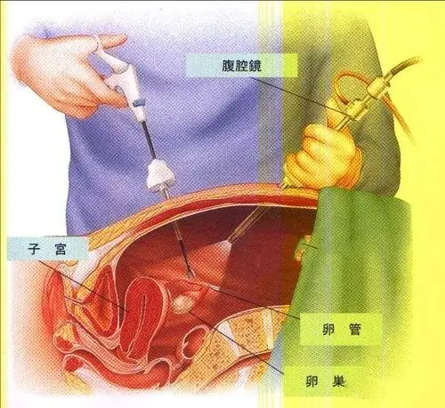做了结扎后悔还来得及吗收好这个怀孕姿势男女都要知道