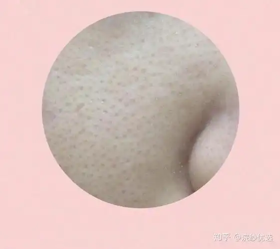 角质厚长什么样? - 知乎