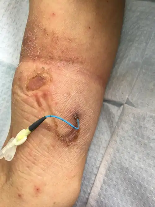 穿刺点渗液刺激皮肤