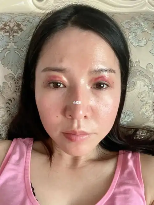 脂肪胶填充眼窝第二天闭眼一坨硬硬的好担