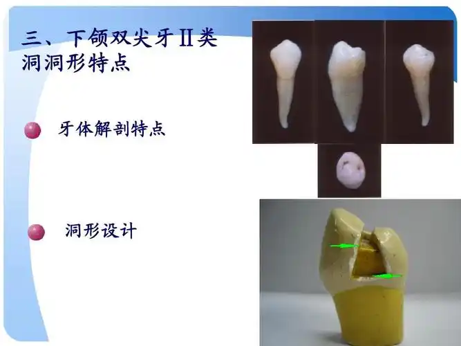 下颌双尖牙Ⅱ 三,下颌双尖牙Ⅱ类 洞洞形特点 牙体解剖特点 洞形设计