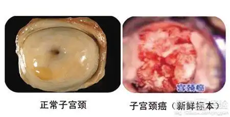 宫颈癌筛查多少钱