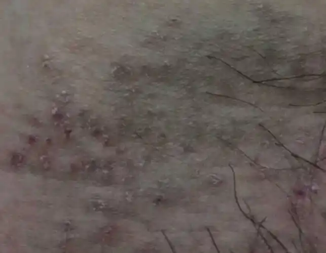 大腿根长红斑和丘疹瘙痒难耐是湿疹还是股癣