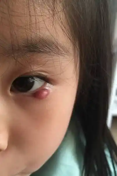 请问以下图中是麦粒肿还是霰粒肿?该如何治疗?