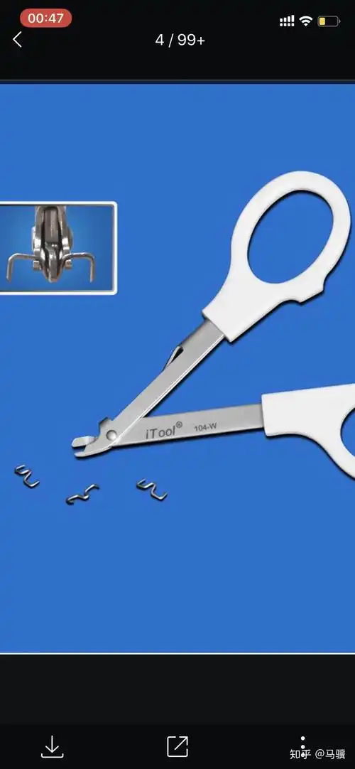 今天是第十四天 全部钉子都掉了,伤口愈合不错,右侧的部分已经很平整