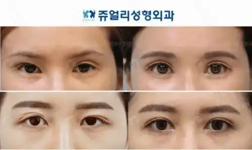 割双眼皮后眼窝凹陷多久能填充自体脂肪和玻尿酸哪个好