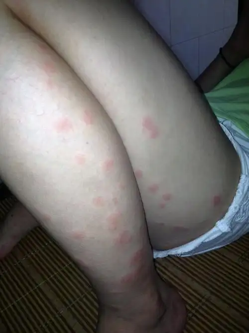 已经全身过敏,有图片,求大家帮助!