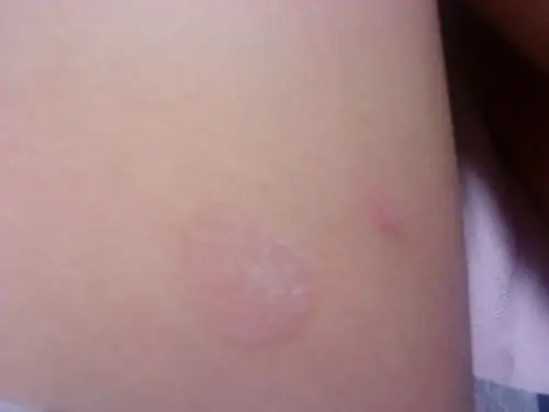 求问,大腿内侧有红色圆形皮癣,不痛不痒,求诸位明确的告诉我什么病