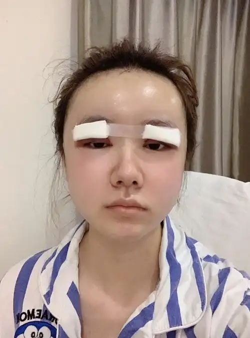 脂肪填充 眼修复记录(一)