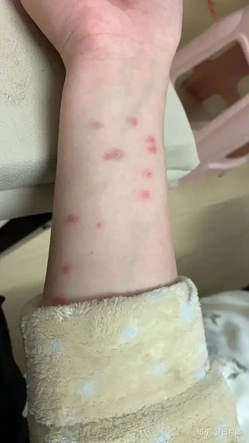 被跳蚤咬的全身都是包是什么样的感受