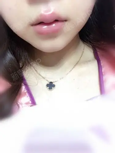 看看嘟嘟唇的效果,第一张是刚打好回到家拍的,后_圈子-新氧美容整形