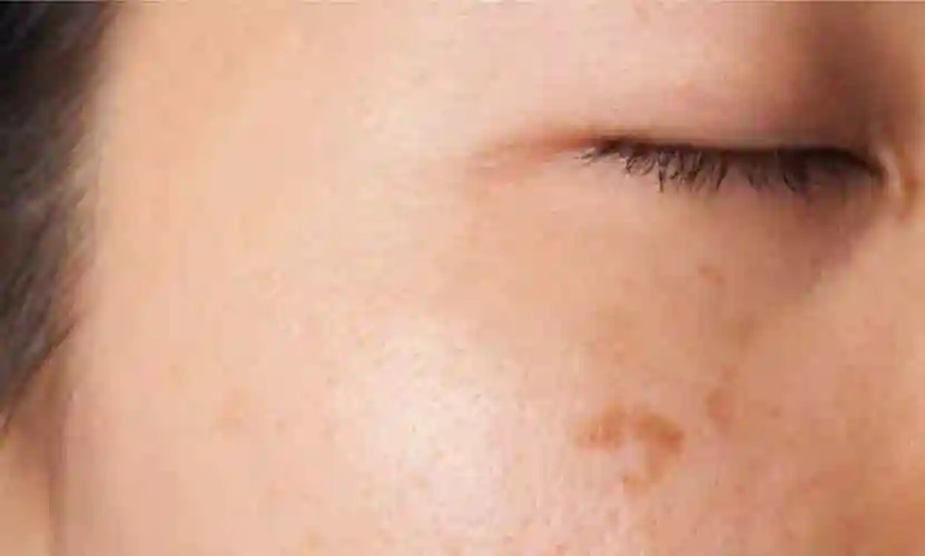 皮肤暗黄必有因,找出原因针对性管理