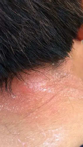 今年50岁,脖子后面出现这样的,只要发热就会痒,就会越来越红,出现水泡