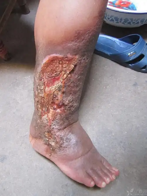 右下肢皮肤淤黑,反复破溃,疼痛 10年