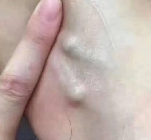 哺乳妈妈腋下长疙瘩,还有副乳是什么原因?对哺乳有什么影响呢?