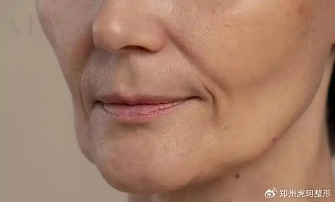 ③皮肤下垂:虽然皮肤松弛也会导致一些下垂现象,但其主要表现为皮肤