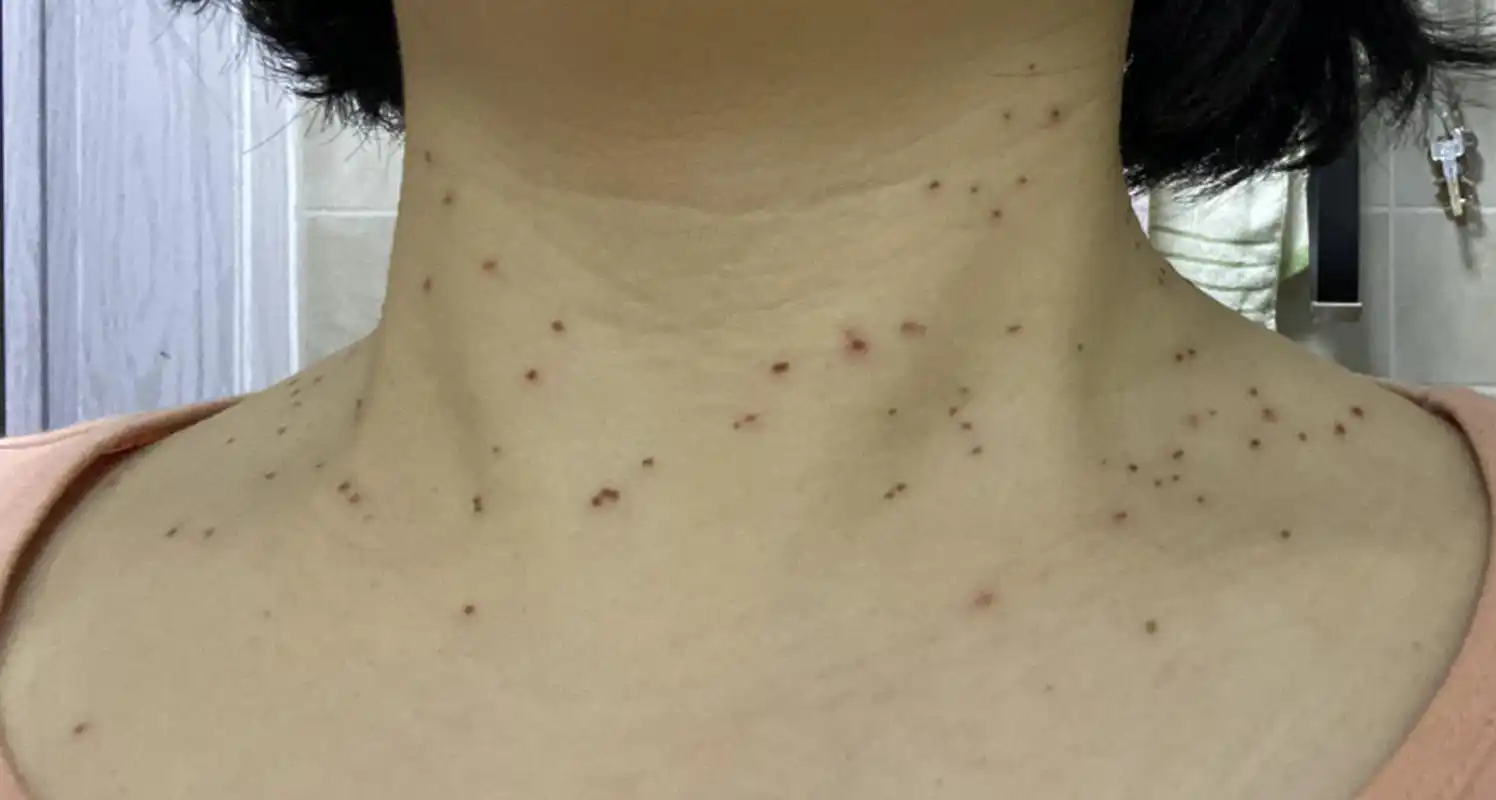 我今年55岁,再婚一年,2个月前,脖子长了几个肉疙瘩,大小跟米粒差不多