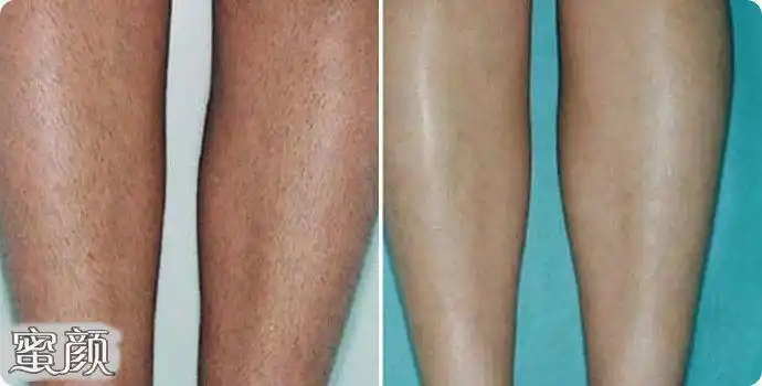 激光去除腿毛的价格大概需要多少呢?