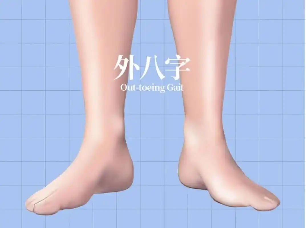 外八字走路危害多! 孩子外八走路危害多!