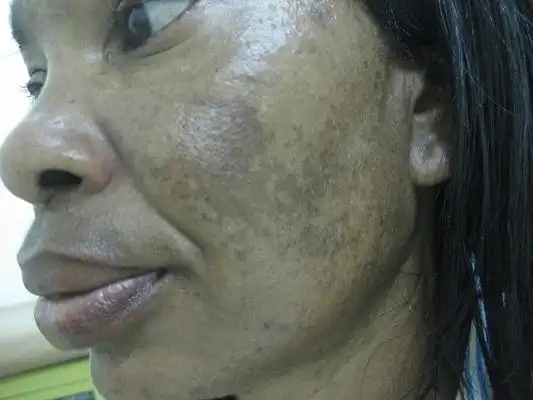 妊娠斑图片 (1)_有来医生