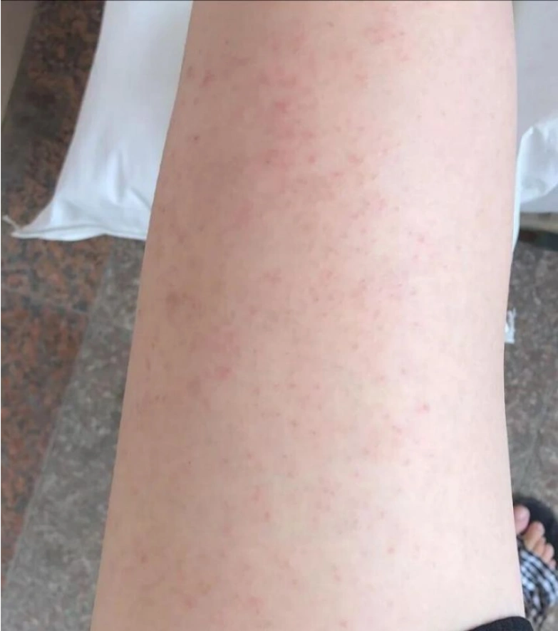 湿疹图片初期症状图片?看图了解湿疹产生的原因有哪些如何治疗