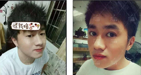 男生割双眼皮前后对比效果图